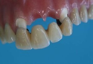 Perte de plusieurs dents - Perte des dents : comment y remédier ?