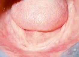 pour une réhabilitation amovible - Les conséquences de la perte des dents