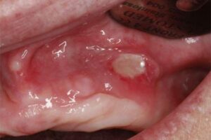 près d’un frein dans la muqueuse blessure avec appareil ortho blessure sous une prothèse - Les douleurs orales d’autres