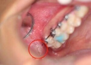 près d’un frein dans la muqueuse blessure avec appareil ortho blessure sous une prothèse - Les douleurs orales d’autres