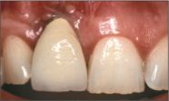 Problème esthétique et difficulté d’entretient - Les conséquences de la perte des dents