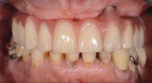 Problème esthétique et difficulté d’entretient - Les conséquences de la perte des dents