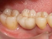 Problème esthétique et difficulté d’entretient - Les conséquences de la perte des dents