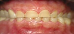 profil concave harmonieux profil plus rectiligne par l’usure profil inversé par une usure exagérée - Embellir son sourir