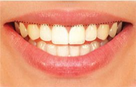 profil concave harmonieux profil plus rectiligne par l’usure profil inversé par une usure exagérée - Embellir son sourir