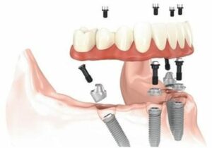 Prothèse complète fixée sur implants - Perte des dents : comment y remédier ?