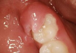 Quand est-il préférable d’enlever les dents de sagesse ? - La croissance harmonieuse du visage