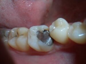 Remplacer un ancien amalgame ( plombage gris) - Embellir son sourire ou une dent fragilisée