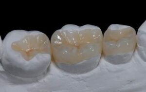 Remplacer un ancien amalgame ( plombage gris) - Embellir son sourire ou une dent fragilisée