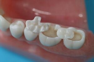 Remplacer un ancien amalgame ( plombage gris) - Embellir son sourire ou une dent fragilisée