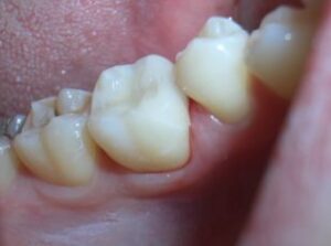Remplacer un ancien amalgame ( plombage gris) - Embellir son sourire ou une dent fragilisée