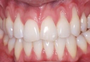 Si elles est sont plus localisées - Les rétractions gingivales et les sensibilités dentaires