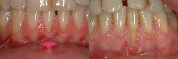 Si elles est sont plus localisées - Les rétractions gingivales et les sensibilités dentaires