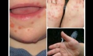 Syndrome main-pied-bouche - Les douleurs orales d’autres origines