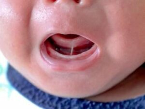 Un frein lingual court - La croissance harmonieuse du visage