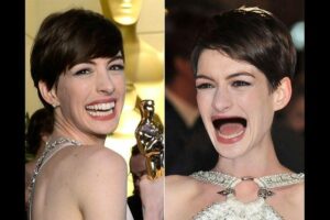 Une dentition harmonieuse: le critère indispensable pour un beau visage - Embellir son sourire ou une dent fragilisée