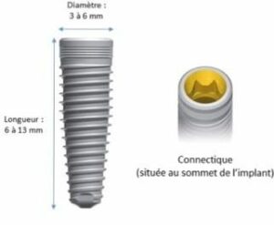 Une solution de choix et garanti - Perte des dents : comment y remédier ?